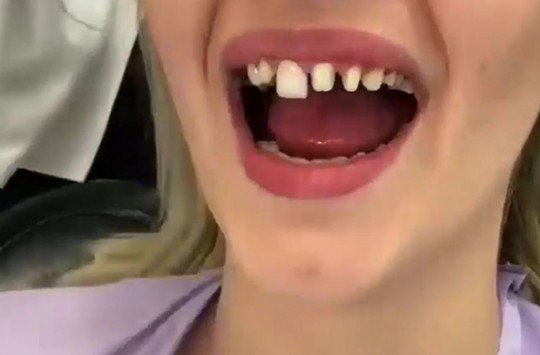 Dişlerini Yaptırdıktan Sonra Tam Anlamıyla Evrim Geçiren Genç Kadın